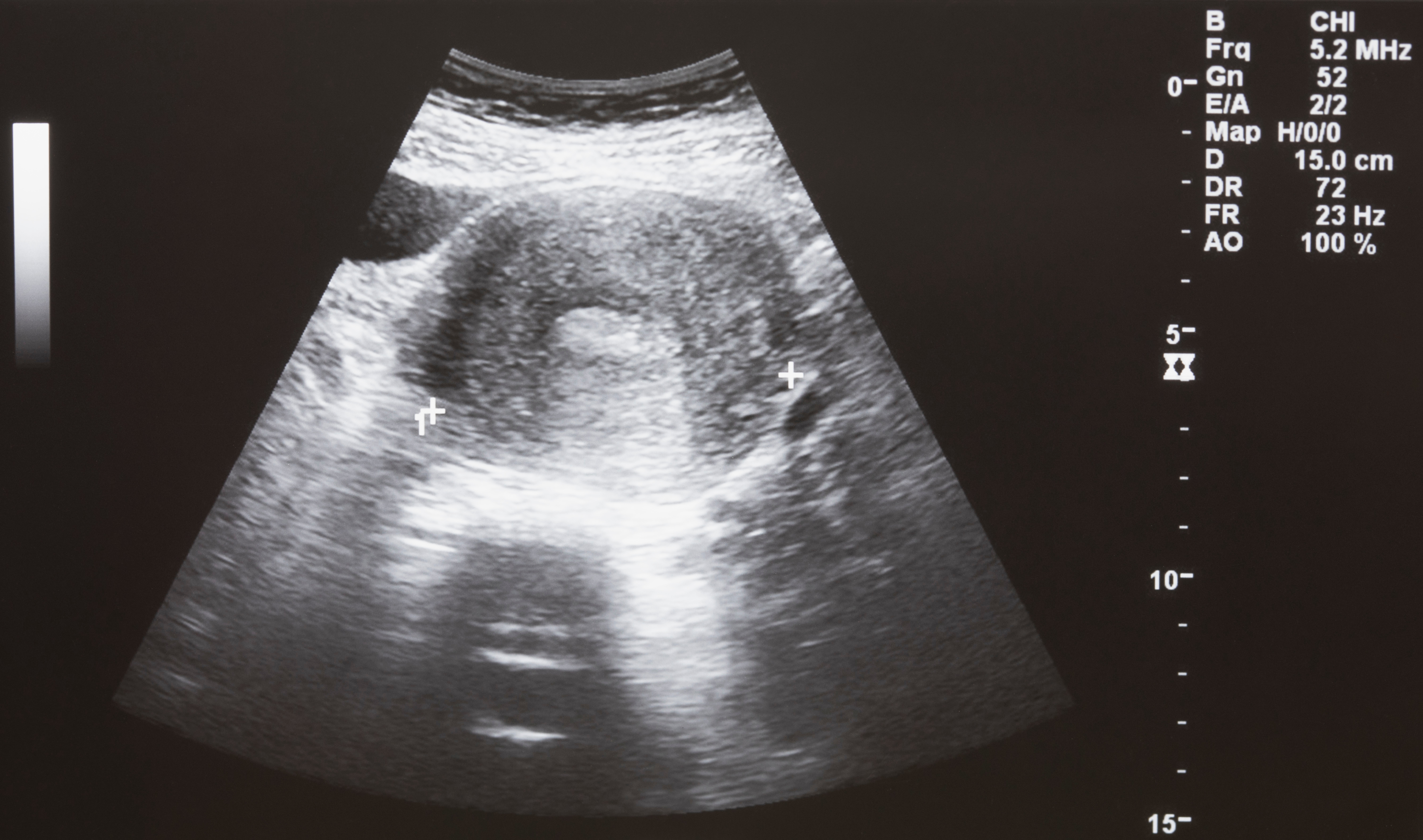 An Obstetrical Mainstay Developing Ai Tools To Optimize Ultrasound 