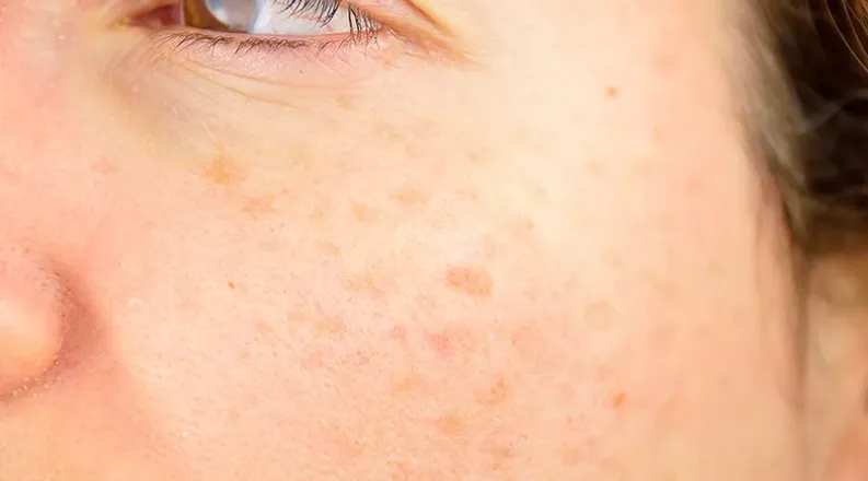 skin spots