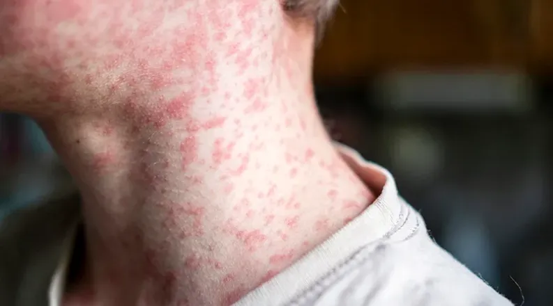 person with red bumps on face and neck.