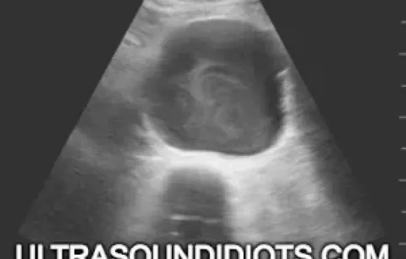 Image of ultrasound with Ultrasoundidiots.com across bottom