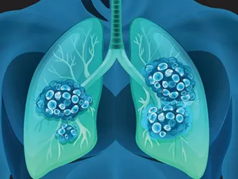 LTC Lung cancer research 358