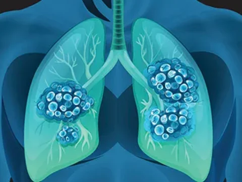 LTC Lung cancer research 358