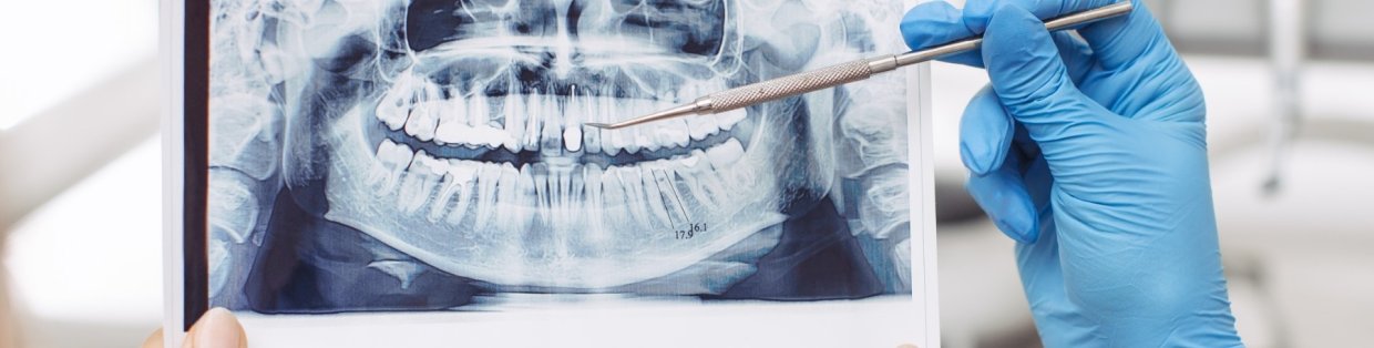 Dental xray of teeth. 