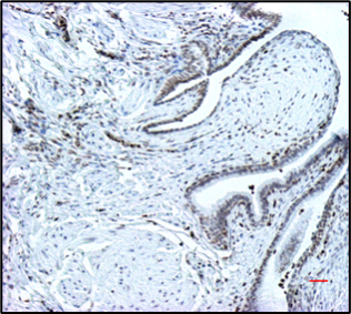 Slide of increased stain (brown) of histone H4K16Ac in lung 